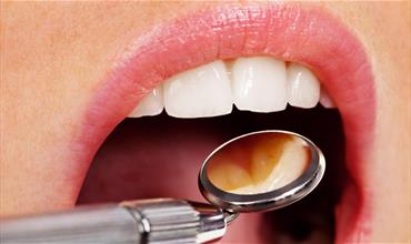 پولیپ دندان چیست؟